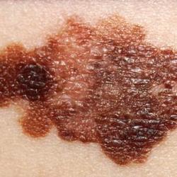 Example of skinCancerAndMelanomas